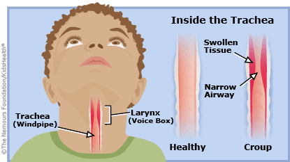 Croup causes airways in the throat to swell