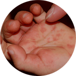 Picture of Hand Foot Mouth Disease Sores_Small